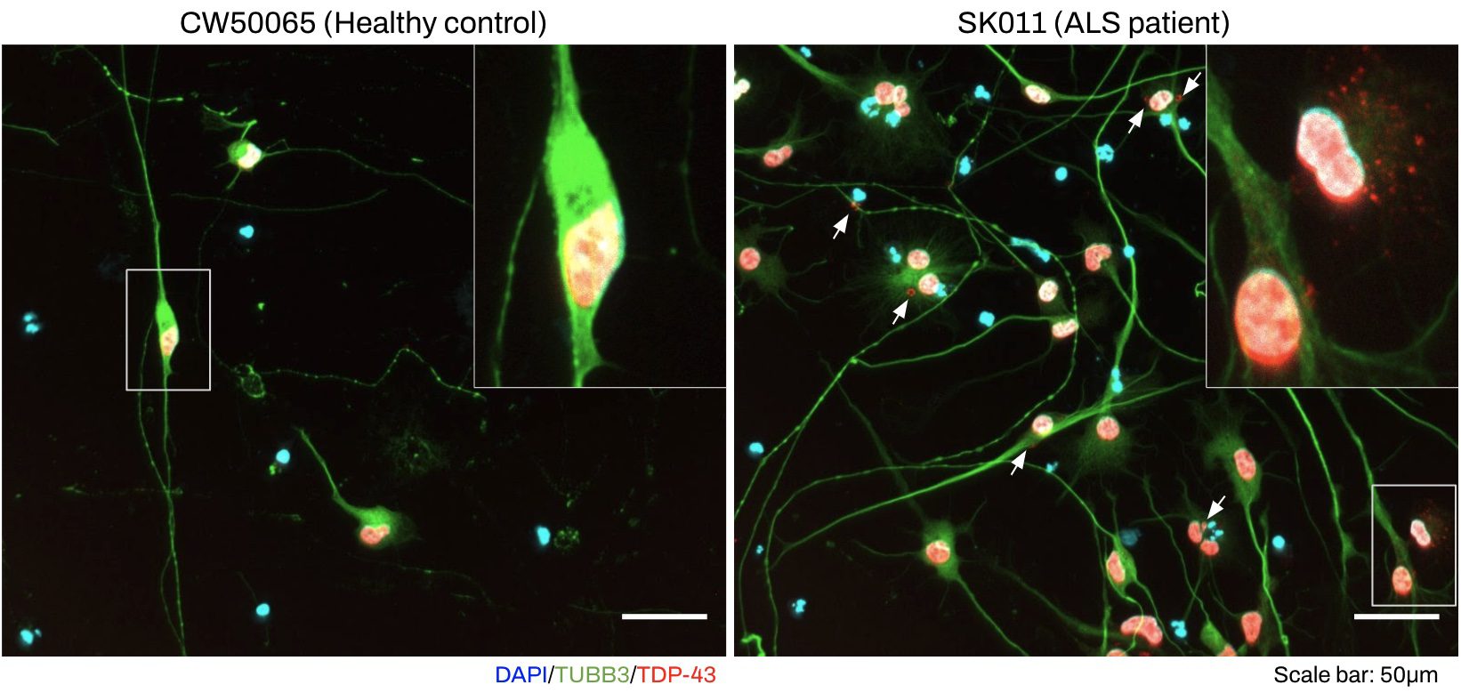 ALS Disease Modeling with Cholinergic neurons differentiated to a Healthy Control and ALS patient from iPSC.